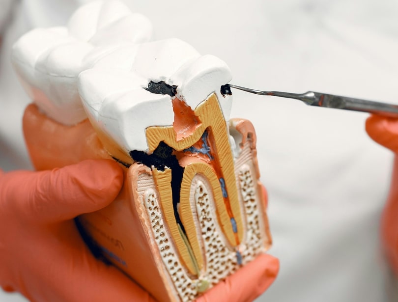 Example of tooth decay