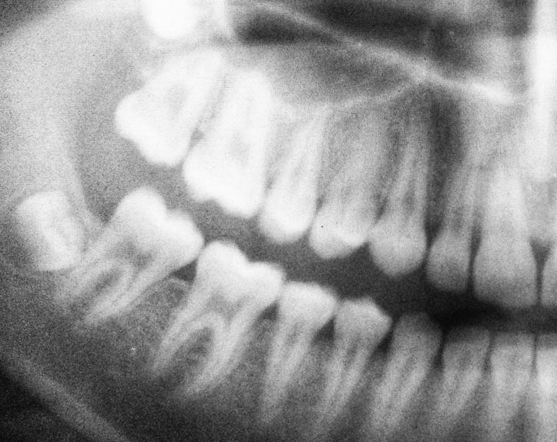 X-ray for jaw bone loss